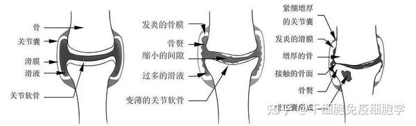 膝关节置换术后疼痛的持续时间解析