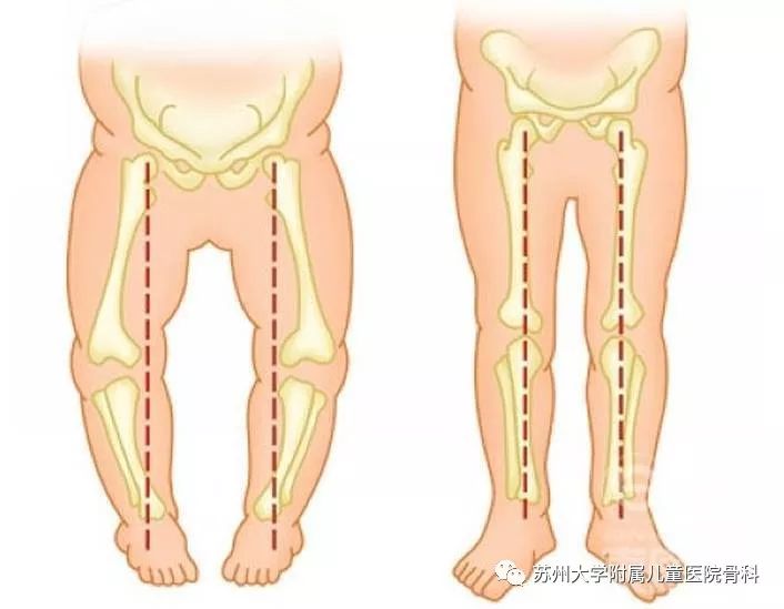 婴儿脚外八字现象，了解、识别与应对