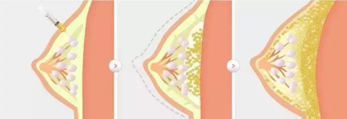 关于四个月宝宝乳房出现硬块的探讨